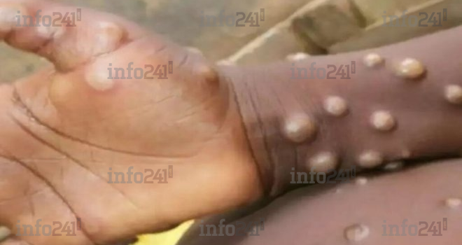 OMS&nbsp;: Près de 88 000 cas de variole du singe recensés dans le monde depuis 2022